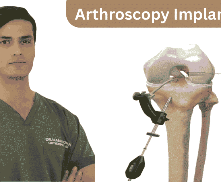 Arthroscopy Implants for Faster and Safer Knee Recovery