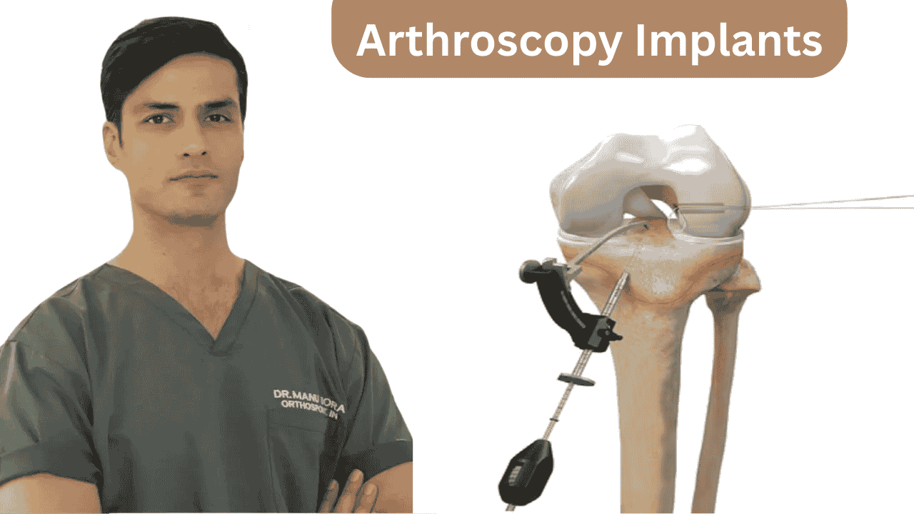 Arthroscopy Implants for Faster and Safer Knee Recovery