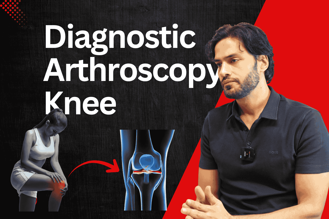Diagnostic Arthroscopy Knee